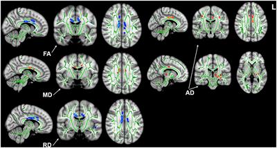 Reorganization of Brain White Matter in Persistent Idiopathic Tinnitus Patients Without Hearing Loss: Evidence From Baseline Data